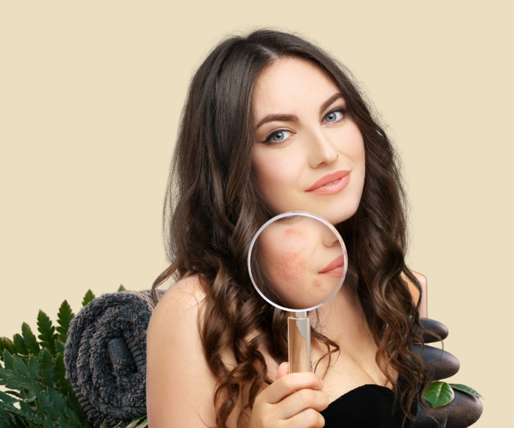 Blog Acne Treatment WillaKrause | Skin Care